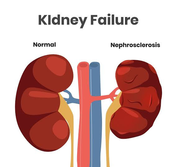 All About Chronic Renal Failure