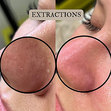 DIAMOND DERMAPLANING