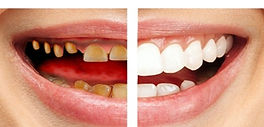 Full-mouth-rehabilitation_edited.jpg