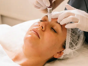 What does Microneedling do to your skin? Discover the benefits below.
