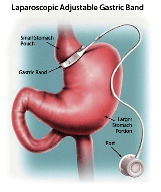 How to lose fat belly without losing weight picture 7