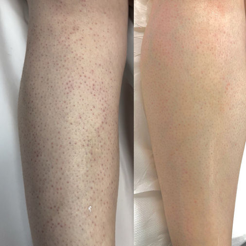 before and after legs hair removal