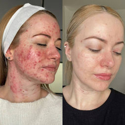 Before and after IPL Dye-VL treatment for rosacea and redness at Monte Clinic London