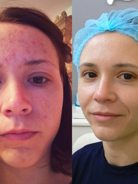 Before and after post acne scars
