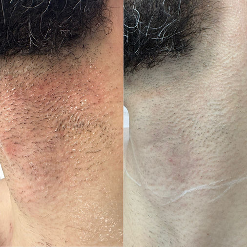 Men Laser Hair Removal at Monte Clinic