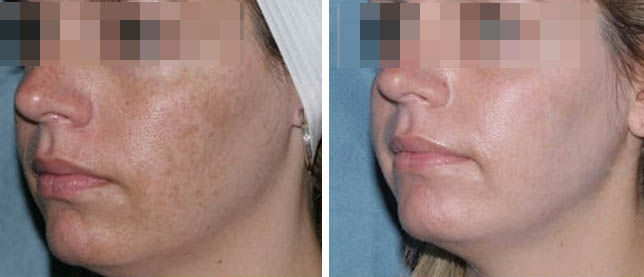 before and after face women