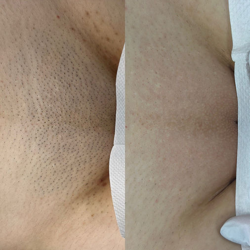 Laser Hair Removal Treatment at Monte Clinic