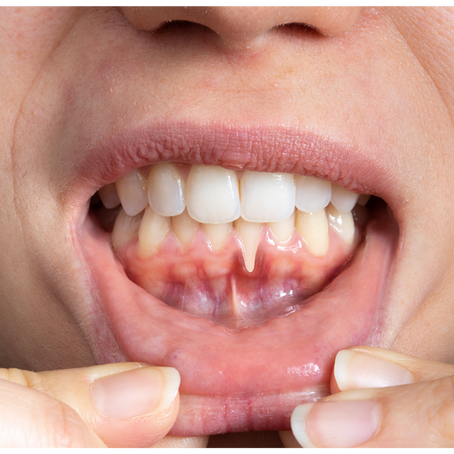 Receding Gums? Here’s How to Protect Your Smile the Gentle Way