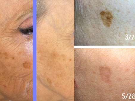 Hyperpigmentation