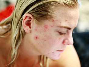 How to Clear Your Acne for Good