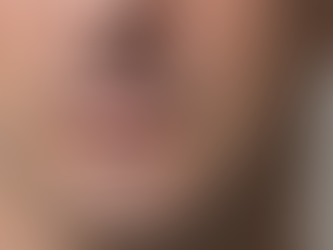 Rosto masculino em imagem realista para matéria sobre preenchimento do bigode chinês e sulco nasogeniano.