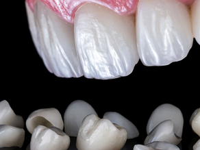 Afinal: O que são as lente de contato dental?