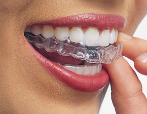 Invisalign.jpg
