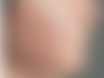 Acne "The sign of puberty"
