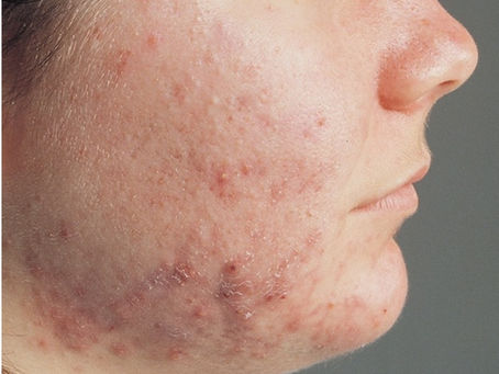 Acne "The sign of puberty"