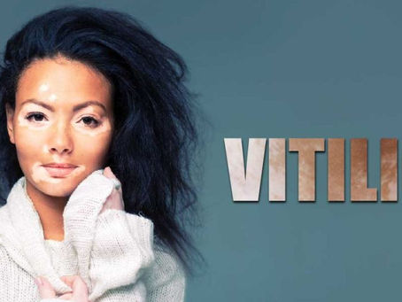 VITILIGO - its ok!
