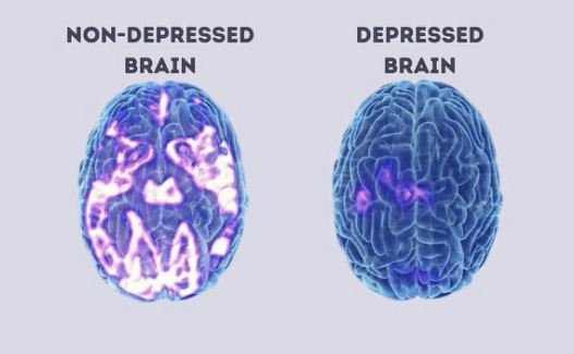 An Image of a depressed and non depressed brain