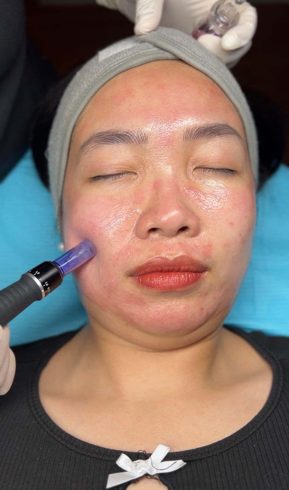 Microneedling done at Miss Derm 