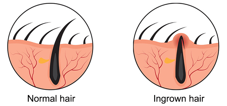 diode vs shave