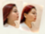 HIFU by Miss Derm