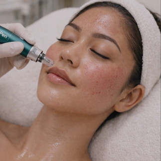 Microneedling by Miss Derm