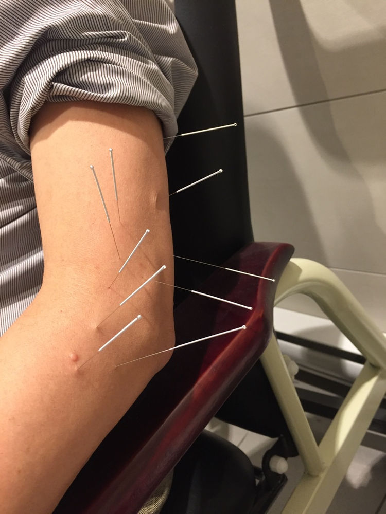 Knee Pain Reduced by Acupuncture