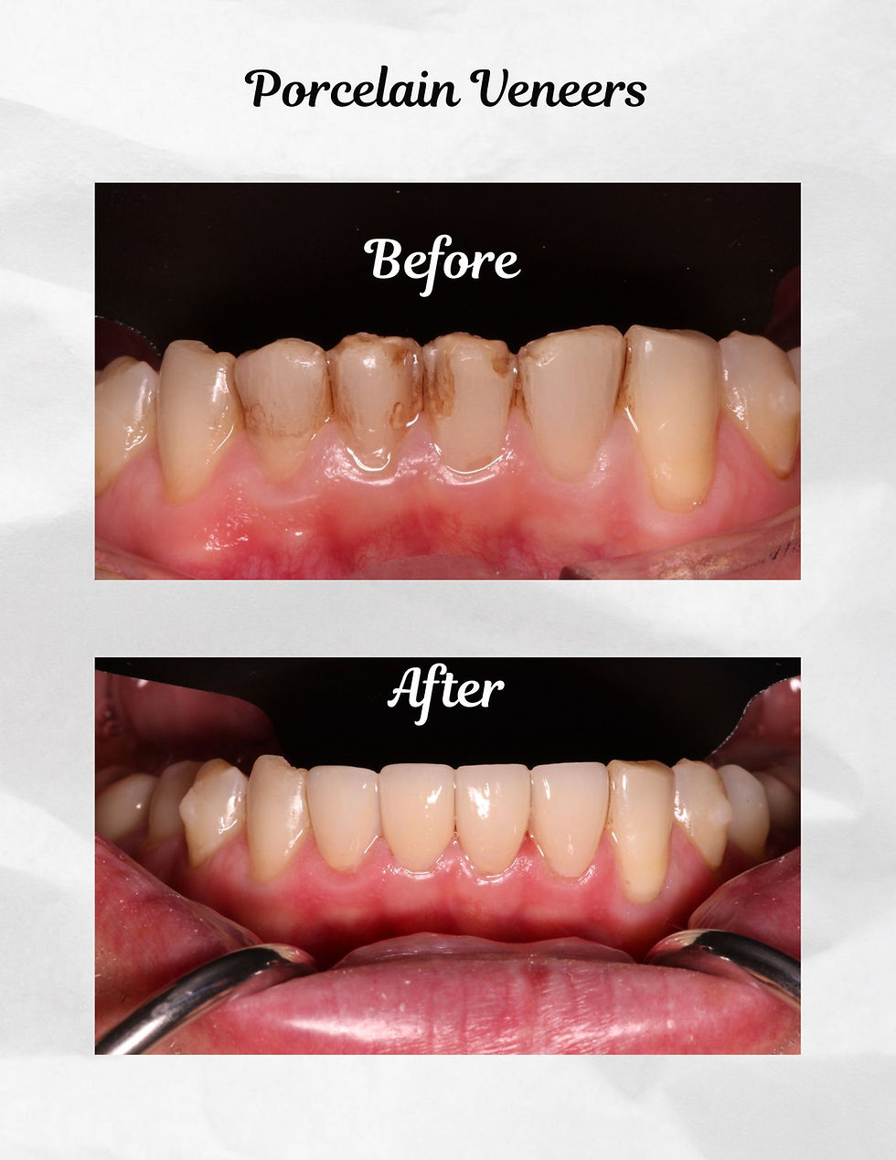 dental porcelain veneers in mountain view, california