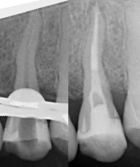 Frakturerede endodontiske instrumenter – håndtering, strategi og prognose