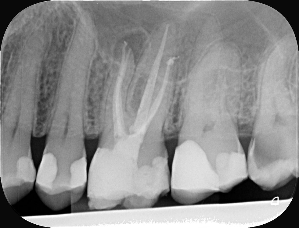 Revisionsbehandling i endodonti – når en rodbehandling fortjener en ny chance
