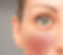 Woman with Rosacea.
