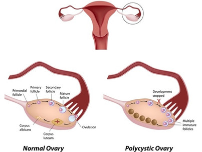 Những điều cần biết về hội chứng buồng trứng đa nang (PCOS)