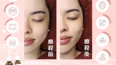 5大暗沉肌膚類型你是那種？ 對應肌膚暗沉的保養方法。 Yanis Beauty全新肌底煥活療程：AquaTX液態細胞微針術，打造透亮年輕肌膚！