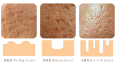 PICO POP 1064｜新一代皮秒科技的進化，精準、快速、安全