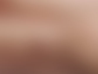 《 疣、血痣、油脂粒、肉粒從何而來?一槍氣化,還你光滑皮膚》