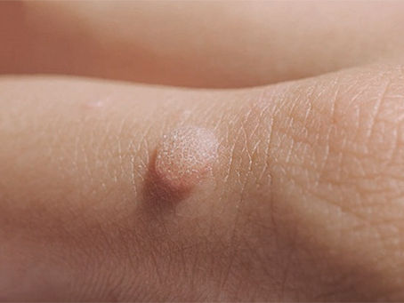 《 疣、血痣、油脂粒、肉粒從何而來？一槍氣化，還你光滑皮膚》