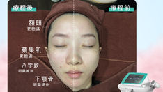 「臉部抗衰」正確思路：了解臉部老化特徵同外源同內源原因，實踐日常護理對抗老化！還原少女肌必試療程！