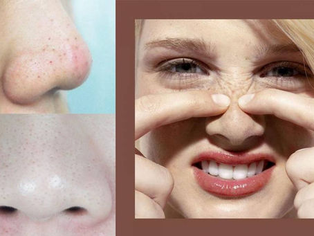  過度清潔反而形成黑頭的主因 ？