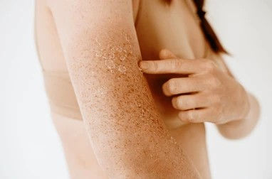 毛孔粗大、凹凸洞、暗瘡印反覆出現？認識新一代煥膚科技 LAP PEEL 療程