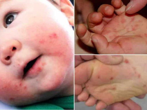 Síndrome mão-pé-boca: saiba o que é