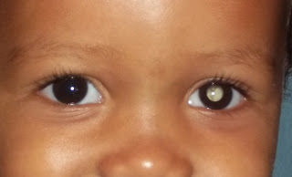 Cuidado com os olhinhos: câncer raro nos olhos, o retinoblastoma, atinge crianças de 0 a 5 anos