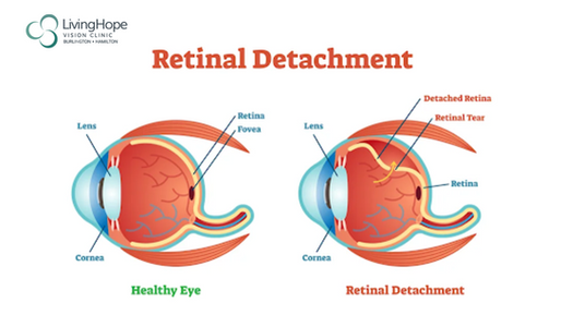 Retinal Detachment, eye care clinic hamilton
