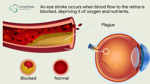 Understanding Stroke in the Eye: Symptoms, Causes and Treatment Options