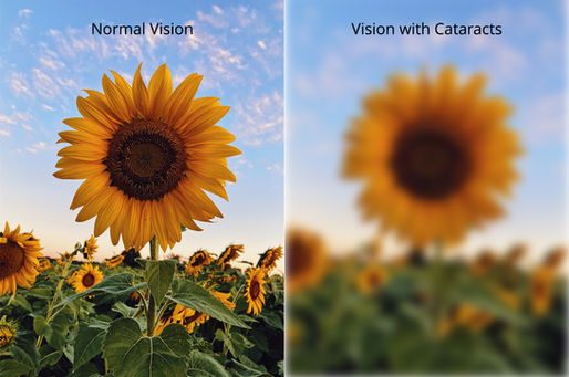 Early Signs of Cataracts: Don’t Let Them Cloud Your Vision
