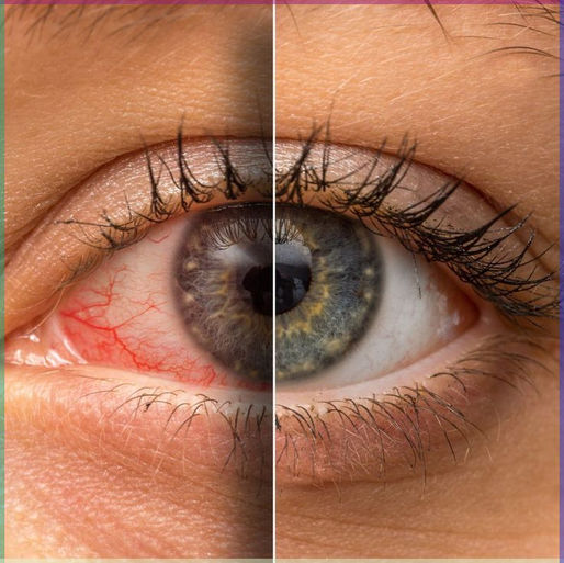 The Role of Diet in Eye Health: Foods to Soothe Dry Eyes