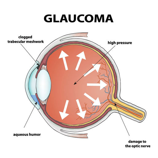 Glaucoma Awareness Month: Protecting Your Vision for the Future