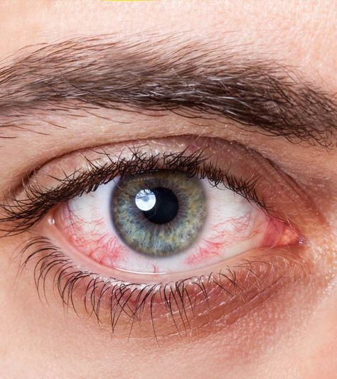 Dry Eye 101: Causes, Symptoms, and When to See Your Optometrist