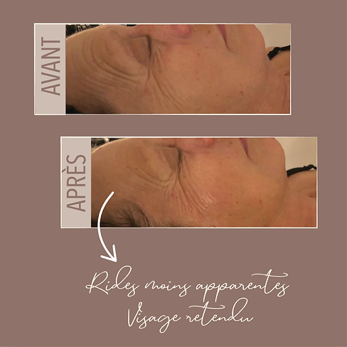 radiofrequence visage