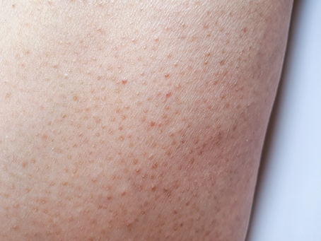 Keratosis Pilaris or "Chicken Skin"