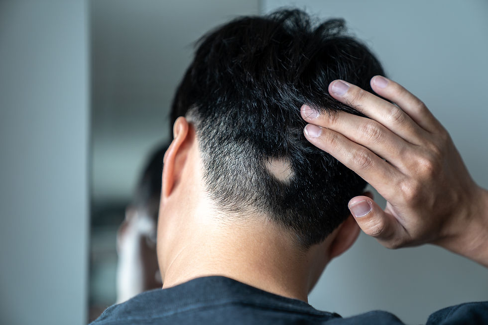 Alopecia Areata Treatments