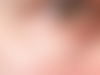 What Are Sebaceous Hyperplasias